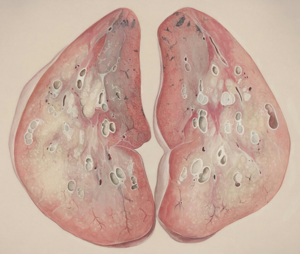 Lung Embolism signs: Symptoms, Causes, Risk Factors, and When to Seek Help Lung Embolism signs